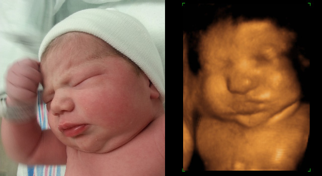 3D ultrasound, before and after pictures.