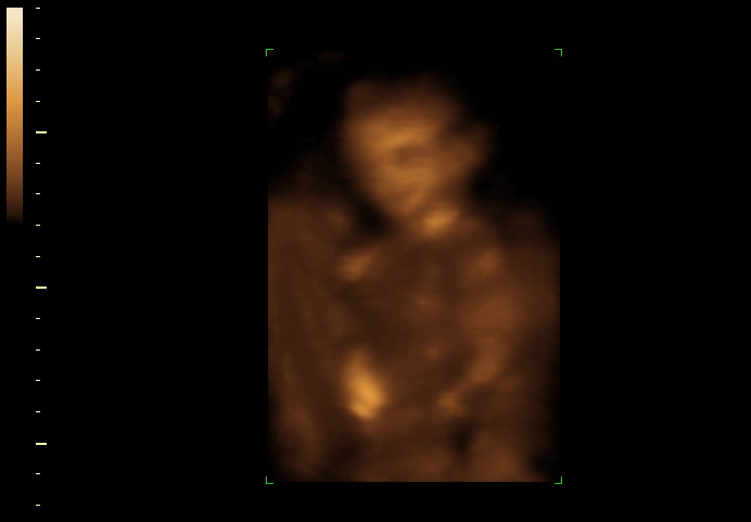 3d sonogram image at 17 weeks