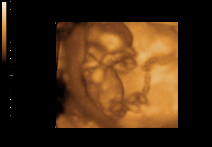 3d sonogram image at 14 weeks