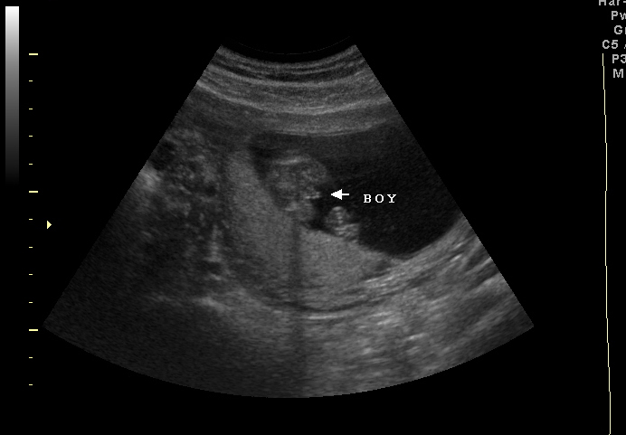 7 week 3d ultrasound