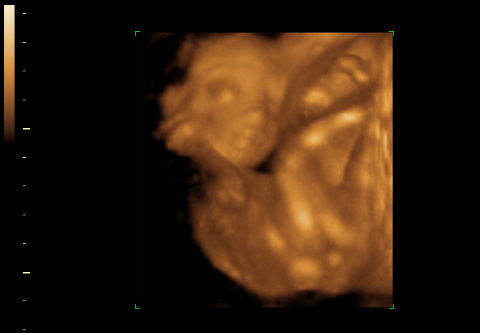 20 week 3d ultrasound face