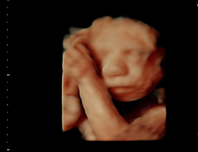 20 weeks pregnant 3d ultrasound